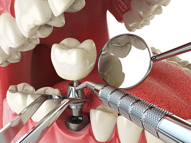 Best Emergency Tooth Extraction in Raton, NM